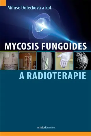 Výhodná Nabídka Mycosis fungoides a radioterapie
